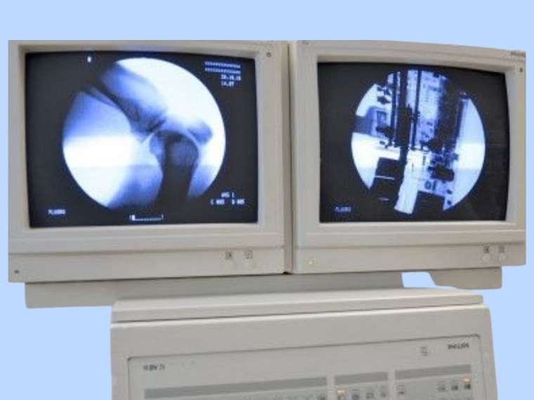 AMPLIFICATEUR DE BRILLANCE PHILIPS BV 29, DOUBLE ECRAN, MEMOIRE D'IMAGE, DOSIMETRE DIAMENTOR E